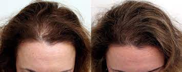 DailyWellness™ Hair Growth Accelerator Soft Chews